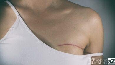 Vai fazer cirurgia de mama? Conheça os riscos e orientações para a correção