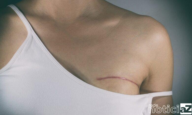 Vai fazer cirurgia de mama? Conheça os riscos e orientações para a correção