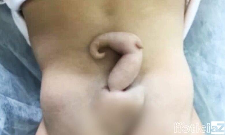 Bebê nasce com cauda de 6 centímetros