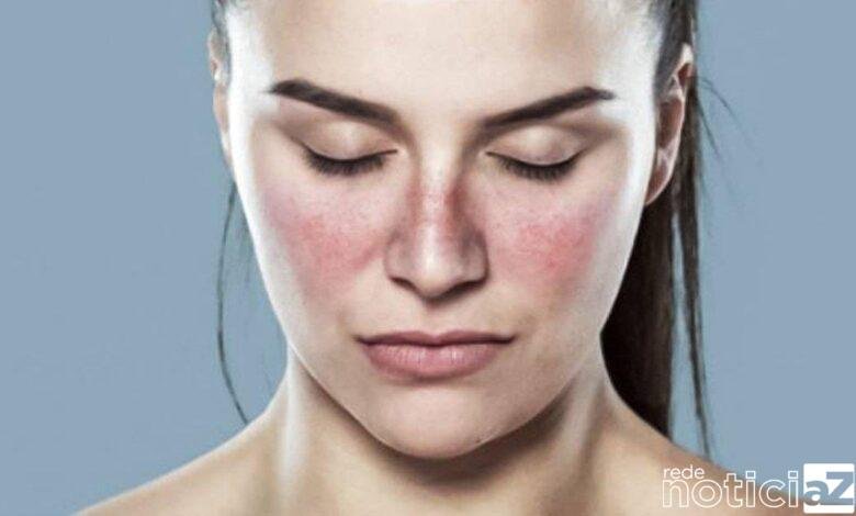 Lúpus: doença autoimune é a mais grave