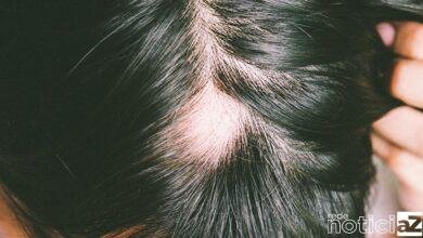 Novela da Globo aborda problema da alopecia