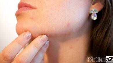 Por que comer chocolate pode fazer com que surja cravos e espinhas?