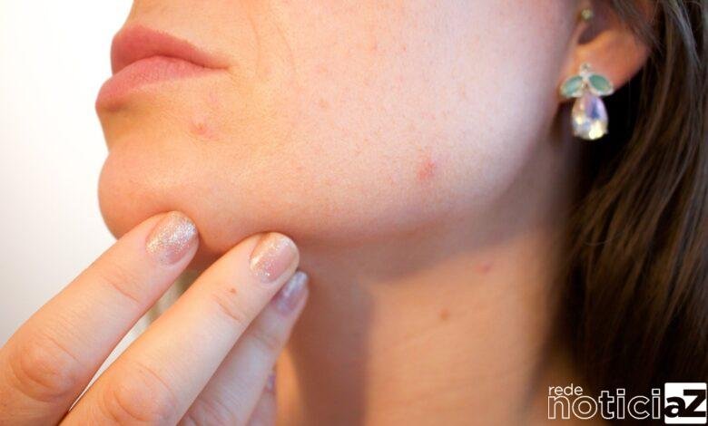 Por que comer chocolate pode fazer com que surja cravos e espinhas?