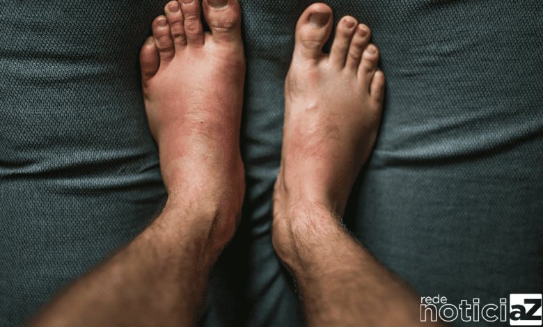 Angioedema hereditário: diagnóstico pode levar até 15 anos