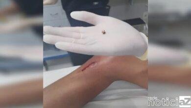 Criança é vítima de espingarda de pressão em Várzea Paulista