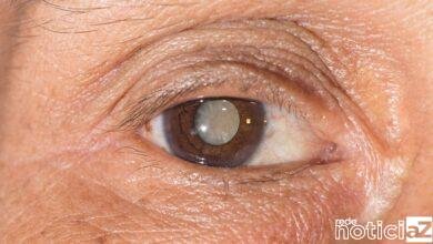 Jundiaí alcança meta de 600 cirurgias de catarata em 2023