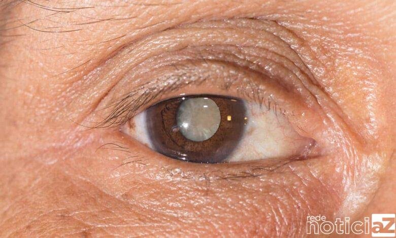 Jundiaí alcança meta de 600 cirurgias de catarata em 2023