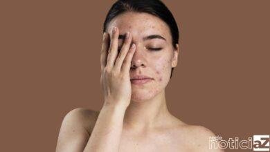 O que você come pode estar te causando acne! Descubra quais são esses alimentos