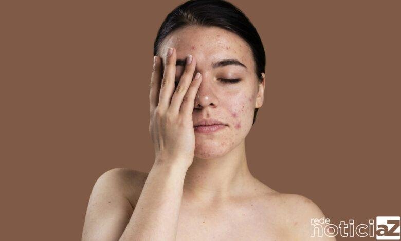 O que você come pode estar te causando acne! Descubra quais são esses alimentos