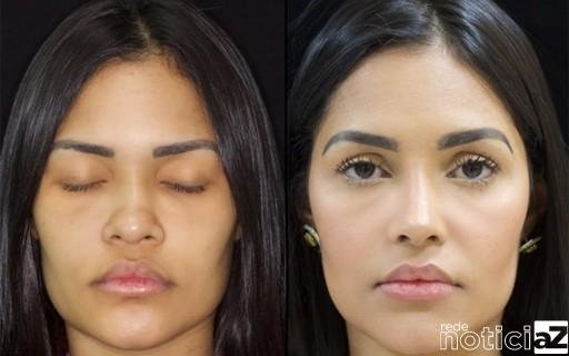 Conheça os ex-BBBs que recorreram a rinoplastia e mudaram o visual