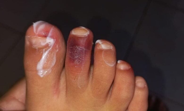 Menina calça tênis, é picada com piolho-de-cobra e vai parar no hospital