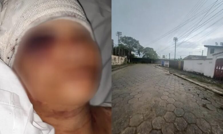Mulher é atacada por cão pitbull no litoral de SP e fica gravemente ferida