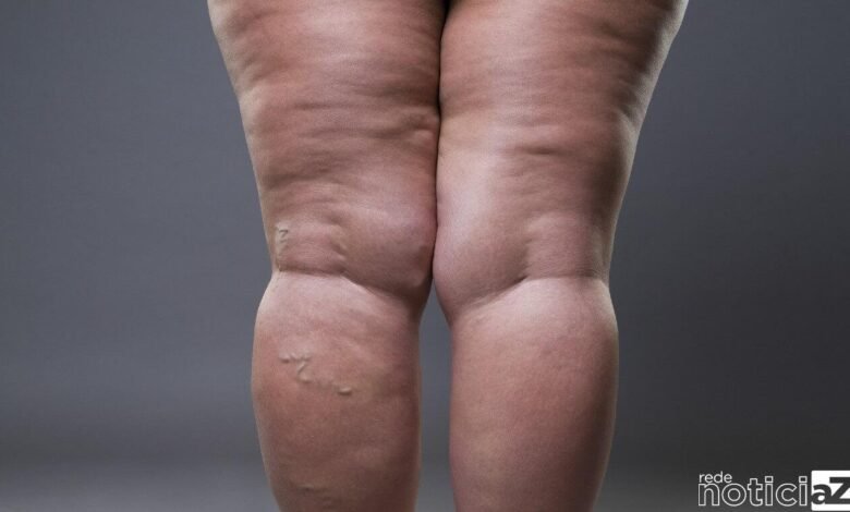 Conheça os 10 sinais para identificar a Lipedema