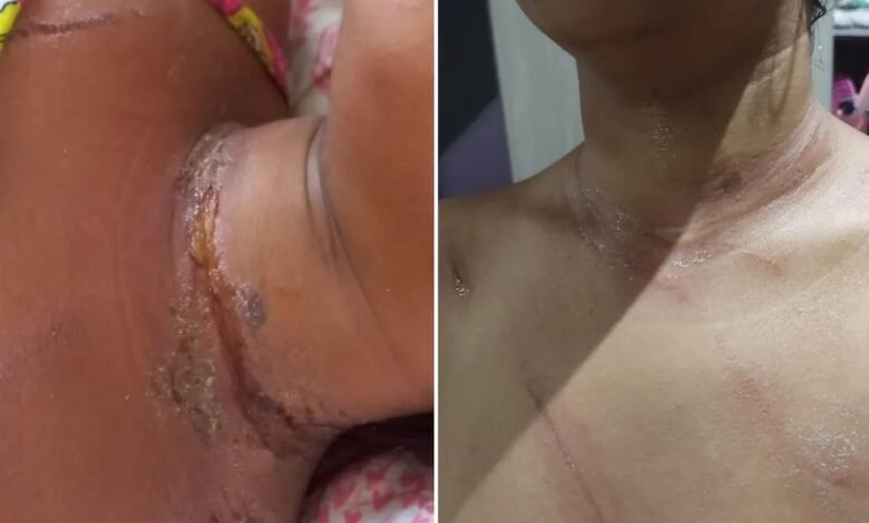 Mulher é quase decapitada após passar de moto por fio de telefonia