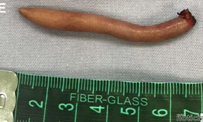 Bebê nasce com uma cauda de 6 centímetros