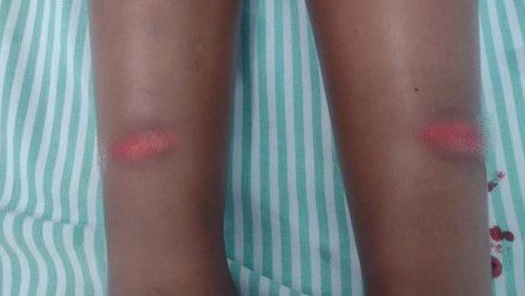 Menina de 6 anos tem pernas cortadas por linha de cerol em Colômbia